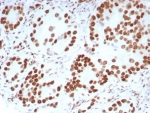 IHC staining of FFPE human prostate carcinoma tissue with Androgen Receptor antibody (clone DHTR/8698R). HIER: boil tissue sections in pH 9 10mM Tris with 1mM EDTA for 20 min and allow to cool before testing.