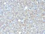 IHC staining of FFPE human hepatocellular carcinoma tissue with Glypican-3 antibody (clone GPC3/7419). HIER: boil tissue sections in pH 9 10mM Tris with 1mM EDTA for 20 min and allow to cool before testing.
