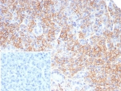 IHC staining of FFPE human pancreas tissue with CD99 antibody (clone rMIC2/6939). Inset: PBS used in place of primary Ab (secondary Ab negative control). HIER: boil tissue sections in pH 9 10mM Tris with 1mM EDTA for 20 min and allow to cool before testing.
