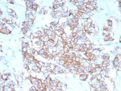 IHC staining of FFPE human breast carcinoma tissue with recombinant HER-2 antibody (clone rERBB2/9401). HIER: boil tissue sections in pH 9 10mM Tris with 1mM EDTA for 20 min and allow to cool before testing.