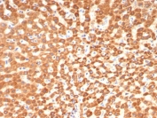 IHC staining of FFPE human hepatocellular carcinoma tissue with SHBG antibody (clone SHBG/8175). HIER: boil tissue sections in pH 9 10mM Tris with 1mM EDTA for 20 min and allow to cool before testing.