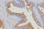 IHC staining of FFPE human prostate carcinoma tissue with recombinant Thymidylate Synthase antibody (clone TYMS/9091R). HIER: boil tissue sections in pH 9 10mM Tris with 1mM EDTA for 20 min and allow to cool before testing.