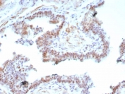 IHC staining of FFPE human prostate carcinoma tissue with recombinant Androgen Receptor V7 antibody (clone DHTR.V7/9125R). HIER: boil tissue sections in pH 9 10mM Tris with 1mM EDTA for 20 min and allow to cool before testing.
