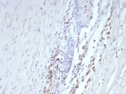 IHC staining of FFPE human prostate tissue with recombinant Transcriptional Regulator ERG antibody (clone ERG/9122R) at 2ug/ml. HIER: boil tissue sections in pH 9 10mM Tris with 1mM EDTA for 20 min and allow to cool before testing.