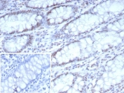 IHC staining of FFPE human colon carcinoma tissue with Cyclin-dependent kinase 4 antibody (clone CDK4/8896). Inset: PBS used in place of primary Ab (secondary Ab negative control). HIER: boil tissue sections in pH 9 10mM Tris with 1mM EDTA for 20 min and allow to cool before testing.