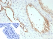 IHC staining of FFPE human prostate carcinoma tissue with Pan-Cadherin antibody (clone Pan-CAD/8019). Inset: PBS used in place of primary Ab (secondary Ab negative control). HIER: boil tissue sections in pH 9 10mM Tris with 1mM EDTA for 20 min and allow to cool before testing.