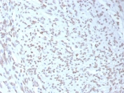 IHC staining of FFPE human liposarcoma tissue with MDM2 antibody (clone MDM2/7943). HIER: boil tissue sections in pH 9 10mM Tris with 1mM EDTA for 20 min and allow to cool before testing.