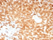 IHC staining of FFPE human hepatocellular carcinoma tissue with AKR1C1 antibody (clone AKR1C1/9070). HIER: boil tissue sections in pH 9 10mM Tris with 1mM EDTA for 20 min and allow to cool before testing.
