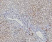 IHC staining of FFPE human hepatocellular carcinoma tissue with AKR1C1 antibody (clone AKR1C1/9317). HIER: boil tissue sections in pH 9 10mM Tris with 1mM EDTA for 20 min and allow to cool before testing.