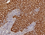 IHC staining of FFPE human hepatocellular carcinoma tissue with AKR1C1 antibody (clone AKR1C1/9319). HIER: boil tissue sections in pH 9 10mM Tris with 1mM EDTA for 20 min and allow to cool before testing.