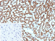 IHC staining of FFPE human hepatocellular carcinoma tissue with CPS1 antibody (clone CPS1/9868). Inset: PBS used in place of primary Ab (secondary Ab negative control). HIER: boil tissue sections in pH 9 10mM Tris with 1mM EDTA for 20 min and allow to cool before testing.