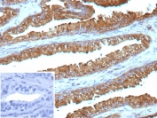 IHC staining of FFPE human prostate cancer tissue with IDH1-R132G antibody (clone IDH1.R132G/13054R). Inset: PBS used in place of primary Ab (secondary Ab negative control). HIER: boil tissue sections in pH 9 10mM Tris with 1mM EDTA for 20 min and allow to cool before testing.