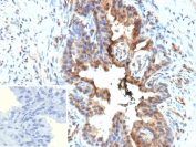 IHC staining of FFPE human prostate tissue with recombinant Galectin 3 antibody (clone LGALS3/13208R). Inset: PBS used in place of primary Ab (secondary Ab negative control). HIER: boil tissue sections in pH 9 10mM Tris with 1mM EDTA for 20 min and allow to cool before testing.