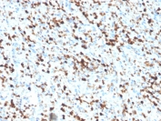 IHC staining of FFPE human spleen tissue with S100A4 antibody (clone S100A4/6802). Inset: PBS used in place of primary Ab (secondary Ab negative control). HIER: boil tissue sections in pH 9 10mM Tris with 1mM EDTA for 20 min and allow to cool before testing.