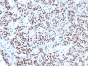 IHC staining of FFPE human thyroid tissue with NKX2.1 antibody (clone NX2.1/9033). HIER: boil tissue sections in pH 9 10mM Tris with 1mM EDTA for 20 min and allow to cool before testing.