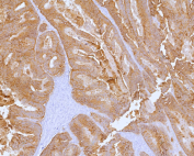 Immunohistochemical analysis of CDH17 in FFPE human colon adenocarcinoma using a CDH17 / Cadherin 17 antibody (clone CDH17/2613). Strong membranous staining is observed in tumor epithelial cells forming glandular structures, consistent with Cadherin 17 expression in intestinal-type epithelium. Staining of formalin-fixed tissues requires heating tissue sections in 10 mM Tris with 1 mM EDTA, pH 9.0, for 45 minutes at 95 C followed by cooling at room temperature for 20 minutes. Inset shows a negative control section processed in parallel using PBS in place of the primary antibody, demonstrating minimal background staining.