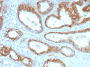 Immunohistochemical analysis of ABCC4 in FFPE human prostate tissue using an ABCC4 antibody (clone ABCC4/9178). Distinct membranous staining is observed in glandular epithelial cells lining prostatic ducts, consistent with ATP-binding cassette sub-family C member 4 localization. Staining of formalin-fixed tissues requires heating tissue sections in 10 mM Tris with 1 mM EDTA, pH 9.0, for 45 minutes at 95 C followed by cooling at room temperature for 20 minutes. Inset shows a negative control section processed in parallel using PBS in place of the primary antibody, demonstrating minimal background staining.