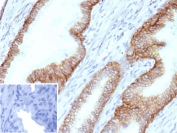 Immunohistochemical analysis of ABCC4 in FFPE human prostate tissue using an ABCC4 antibody (clone ABCC4/9178). Brown membranous and cytoplasmic staining is observed in epithelial cells, consistent with ATP-binding cassette sub-family C member 4 localization. Staining of formalin-fixed tissues requires heating tissue sections in 10 mM Tris with 1 mM EDTA, pH 9.0, for 45 minutes at 95 C followed by cooling at room temperature for 20 minutes. Inset shows a negative control section processed in parallel using PBS in place of the primary antibody, demonstrating minimal background staining.