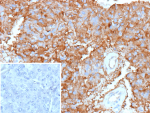 Immunohistochemistry analysis of formalin-fixed, paraffin-embedded human adrenal gland tissue using recombinant Apolipoprotein J/ApoJ antibody (clone r7D1). Diffuse cytoplasmic staining is observed in adrenal cortical cells, with granular signal distribution and variable intensity across the tissue. Vascular and stromal elements show minimal background staining. Nuclei are counterstained in blue. Inset shows PBS substituted for the primary antibody as a secondary-only negative control. Heat-induced antigen retrieval was performed by heating tissue sections in 10 mM Tris with 1 mM EDTA, pH 9.0, for 45 minutes at 95oC, followed by cooling at room temperature for 20 minutes.