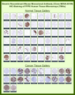 Immunohistochemistry tissue microarray analysis of Desmin expression. DES/Desmin antibody (clone MSVA-651M) was evaluated by immunohistochemistry on formalin-fixed, paraffin-embedded human tissue microarrays encompassing a wide range of normal and cancer tissues. Staining demonstrates cytoplasmic labeling in muscle-containing tissues and mesenchymal components consistent with known Desmin expression patterns, with strong reactivity observed in skeletal, cardiac, and smooth muscle compartments and variable expression across tumor types. Overall staining distribution and relative expression profiles are concordant with publicly available expression data reported by the Human Protein Atlas, supporting the biological relevance of the observed immunoreactivity.
