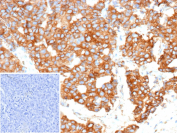 Immunohistochemistry of HER2 expression in human breast tissue. Formalin-fixed, paraffin-embedded human breast tissue stained with HER2 antibody (clone r5A2) shows predominantly cytoplasmic staining in epithelial tumor cells, with variable membrane-associated signal. Inset shows negative control with PBS substituted for the primary antibody. Tissue sections were processed using heat-induced antigen retrieval (10mM Tris with 1mM EDTA, pH 9.0, for 45 min at 95oC) prior to immunostaining and chromogenic detection.