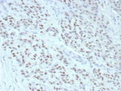 Immunohistochemistry analysis of Estrogen receptor alpha in human breast tissue. Formalin-fixed, paraffin-embedded human breast tissue was stained using recombinant ESR1/Estrogen receptor 1 antibody (clone rESR1/9525), showing clear nuclear immunoreactivity in epithelial cells consistent with Estrogen receptor 1 expression. Heat-induced epitope retrieval was performed by heating tissue sections in 10 mM Tris with 1 mM EDTA, pH 9.0, at 95oC for 45 minutes, followed by cooling at room temperature for 20 minutes prior to immunostaining.