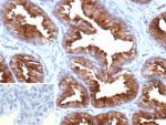 Immunohistochemistry of PSMA in human prostate tissue. Formalin-fixed, paraffin-embedded human prostate tissue stained with recombinant FOLH1/Prostate-specific membrane antigen antibody (FOLH1/9735R). Brown chromogenic signal indicates PSMA-positive epithelial cells with cytoplasmic and membranous staining. Inset shows PBS substituted for the primary antibody as a secondary-only negative control. Heat-induced epitope retrieval was performed by heating tissue sections in 10mM Tris with 1mM EDTA, pH 9.0, for 45 min at 95oC followed by cooling at room temperature for 20 min.