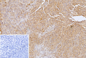 Formalin-fixed, paraffin-embedded human melanoma stained with GPC3/Glypican-3 antibody (clone GPC3/12698). Tumor cells show diffuse cytoplasmic and membranous brown chromogenic staining, consistent with Glypican-3 expression in melanoma cells, while nuclei are counterstained blue. Inset shows a PBS-only negative control processed without primary antibody, demonstrating minimal non-specific background staining.
