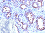 Formalin-fixed, paraffin-embedded human breast carcinoma stained with recombinant GSTP1/Glutathione S-transferase pi 1 antibody (clone GSTP1/12956R). Tumor epithelial cells show cytoplasmic brown chromogenic staining consistent with GSTP1 expression, while surrounding stromal cells display minimal signal; nuclei are counterstained blue. Inset shows a PBS-only negative control processed without primary antibody, confirming minimal non-specific background staining.