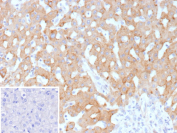 Formalin-fixed, paraffin-embedded human hepatocellular carcinoma stained with HSD17B13/Hydroxysteroid 17 beta dehydrogenase 13 antibody (clone HSD17B13/13105). Tumor hepatocytes show diffuse cytoplasmic brown chromogenic staining consistent with Hydroxysteroid 17 beta dehydrogenase 13 expression, while nuclei are counterstained blue. Inset shows a PBS-only negative control processed without primary antibody, demonstrating minimal non-specific background staining.