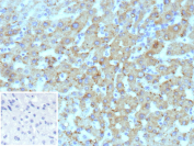 Formalin-fixed, paraffin-embedded human hepatocellular carcinoma stained with Hepatic lipid droplet protein antibody (clone HSD17B13/13107). Tumor hepatocytes show diffuse cytoplasmic brown chromogenic staining consistent with hepatic lipid droplet-associated 17 beta hydroxysteroid dehydrogenase type 13 expression, while nuclei are counterstained blue. Inset shows a PBS-only negative control processed without primary antibody, demonstrating minimal non-specific background staining.