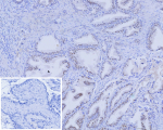Immunohistochemistry analysis of recombinant AR / Androgen receptor antibody (clone r2F12) in human prostate. Formalin-fixed, paraffin-embedded human prostate tissue shows nuclear brown chromogenic staining in glandular epithelial cells, consistent with androgen receptor-positive prostate epithelium and expected nuclear localization of this steroid hormone receptor. The inset shows a PBS-only negative control processed without primary antibody, demonstrating minimal non-specific background staining.