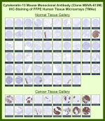 Immunohistochemistry analysis of Suprabasal squamous keratin / Cytokeratin 13 antibody (clone MSVA-613M) in human tissues. Formalin-fixed, paraffin-embedded (FFPE) human tissue microarrays containing a broad panel of normal and cancer tissues were stained with Cytokeratin 13 mouse monoclonal antibody (clone MSVA-613M). In normal tissues, brown chromogenic signal is observed predominantly in suprabasal squamous epithelial cells, including esophageal squamous epithelium, tonsillar surface epithelium, ectocervix, and urothelium, while most non-squamous tissues show little to no staining. In cancer tissues, strong cytoplasmic brown staining is observed in squamous cell carcinomas, whereas non-squamous malignancies such as adenocarcinomas and mesothelioma are largely negative. Staining patterns are consistent with known Cytokeratin 13 / KRT13 expression profiles reported in publicly available expression datasets.