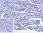 Formalin-fixed, paraffin-embedded human colon adenocarcinoma stained with MCM4 Recombinant Rabbit Monoclonal Antibody (MCM4/13209R). Inset: PBS instead of primary antibody; secondary only negative control.