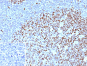 Immunohistochemistry analysis of MCM5/MCM complex protein 5 antibody (clone MCM5/3200) in human tonsil. Formalin-fixed, paraffin-embedded human tonsil shows strong nuclear brown staining in proliferating lymphoid cells within germinal centers, consistent with MCM complex protein 5 expression in actively cycling B cells, while surrounding mantle zone lymphocytes demonstrate reduced staining intensity. The inset shows PBS used in place of primary antibody as a negative control, confirming absence of non-specific nuclear staining. Heat-induced epitope retrieval was performed by heating tissue sections in 10mM Tris with 1mM EDTA, pH 9.0, for 45 min at 95oC followed by cooling at room temperature for 20 minutes prior to staining.