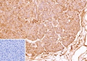 IHC staining of FFPE human pancreas tissue with recombinant MIC2/CD99 antibody (clone MIC2/9939R). Pancreatic epithelial cells demonstrate membranous and cytoplasmic staining. Inset: PBS instead of primary antibody; secondary only negative control. HIER: boil tissue sections in pH 9 10mM Tris with 1mM EDTA for 45 min at 95oC followed by cooling at RT for 20 minutes.