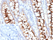 Immunohistochemistry analysis of Nonspecific Cross-Reacting Antigen 90 / CEACAM6 antibody (clone CEACAM6/10079R) in human colon carcinoma tissue. Formalin-fixed, paraffin-embedded human colon carcinoma shows strong membranous and apical brown chromogenic staining in tumor epithelial cells, consistent with CEACAM6 expression, while surrounding stromal elements are largely negative. The inset image shows PBS used in place of primary antibody as a negative control, demonstrating absence of specific staining. Heat-induced epitope retrieval was performed by boiling tissue sections in 10mM Tris with 1mM EDTA, pH 9.0, for 45 min at 95oC followed by cooling at RT for 20 minutes.