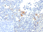 Immunohistochemistry analysis of Melanocyte Lineage / PMEL antibody in human melanoma tissue. FFPE human melanoma sections show focal HRP-DAB brown cytoplasmic staining in scattered tumor cells, consistent with premelanosome-associated localization of PMEL in melanocytic cells. Adjacent tumor cells demonstrate weak or minimal staining, reflecting heterogeneous expression within the lesion. The inset negative control, in which PBS was used in place of primary antibody, shows no specific brown chromogenic signal. Heat induced epitope retrieval was performed in 10 mM Tris with 1 mM EDTA, pH 9.0, by boiling for 10-20 minutes followed by cooling at room temperature for 20 minutes prior to antibody incubation.