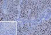 Immunohistochemistry analysis of SOX10 antibody (clone rSOX10/13506) in formalin-fixed, paraffin-embedded human melanoma tissue. Strong nuclear staining is observed in tumor cells, consistent with SRY-box transcription factor 10 expression in melanocytic lineage cells. The inset shows PBS used in place of primary antibody as a negative control, demonstrating absence of specific staining. Antigen retrieval was performed by heating tissue sections in 10 mM Tris with 1 mM EDTA, pH 9.0, for 45 minutes at 95oC followed by cooling at room temperature for 20 minutes.