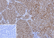 Immunohistochemistry analysis of Transcription factor SOX10 antibody (clone rSOX10/991) in formalin-fixed, paraffin-embedded human melanoma tissue. Strong and diffuse nuclear staining is observed in tumor cells, consistent with SOX10 expression in melanocytic lineage cells. The inset shows PBS used in place of primary antibody as a negative control, demonstrating absence of specific staining. Antigen retrieval was performed by heating tissue sections in 10 mM Tris with 1 mM EDTA, pH 9.0, for 45 minutes at 95oC followed by cooling at room temperature for 20 minutes.