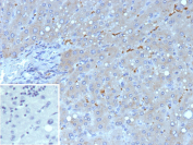 Immunohistochemistry analysis of TCF2 / HNF1B antibody in human liver carcinoma tissue (clone HNF1B/9519). FFPE human liver carcinoma sections show HRP-DAB brown nuclear staining in scattered tumor epithelial cells, consistent with nuclear localization of Hepatocyte nuclear factor 1 beta. Surrounding stromal areas demonstrate minimal to absent staining. The inset shows PBS used in place of primary antibody as a secondary antibody negative control, confirming absence of specific brown signal. Heat induced epitope retrieval was performed in 10 mM Tris with 1 mM EDTA, pH 9.0, by heating tissue sections at 95oC for 45 minutes followed by cooling at room temperature for 20 minutes prior to antibody incubation.