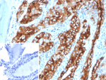 Immunohistochemistry analysis of Thyroid Globulin / TG antibody in human thyroid tissue (clone TGB/4582R). FFPE human thyroid sections demonstrate strong HRP-DAB brown cytoplasmic staining in follicular epithelial cells, with intense brown chromogenic signal filling the follicular lumina corresponding to colloid material. The staining pattern is consistent with abundant Thyroglobulin synthesis and secretion by differentiated thyroid follicular cells. Surrounding stromal elements show minimal staining. The inset shows PBS used in place of primary antibody as a secondary antibody negative control, confirming absence of specific brown chromogenic signal. Heat induced epitope retrieval was performed in 10 mM Tris with 1 mM EDTA, pH 9.0, by heating tissue sections at 95oC for 45 minutes followed by cooling at room temperature for 20 minutes prior to antibody incubation.