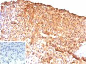 Immunohistochemistry analysis of UPK2 antibody in human bladder carcinoma. Formalin-fixed, paraffin-embedded human bladder cancer tissue was stained with Uroplakin II recombinant rabbit monoclonal antibody (clone UPK2/13669R). Strong HRP-DAB brown membranous and cytoplasmic staining is observed in tumor epithelial cells, consistent with Uroplakin 2 expression in urothelial-derived carcinoma. The staining highlights cell membranes and apical surfaces with diffuse cytoplasmic signal in positive tumor cells, while adjacent stromal elements show minimal background staining. Inset: PBS was used in place of the primary antibody as a negative control. Heat-induced epitope retrieval was performed in 10mM Tris with 1mM EDTA, pH 9.0, for 45 min at 95oC followed by cooling at room temperature for 20 minutes.