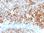 Immunohistochemistry analysis of UPK2 antibody in human bladder carcinoma. Formalin-fixed, paraffin-embedded human bladder cancer tissue was stained with Uroplakin II recombinant rabbit monoclonal antibody (clone UPK2/13348R). Strong HRP-DAB brown membranous and cytoplasmic staining is observed in tumor epithelial cells, consistent with Uroplakin 2 expression in urothelial-derived carcinoma. The staining highlights cell membranes with circumferential membranous accentuation and granular cytoplasmic signal, while adjacent stromal tissue shows minimal background staining. Inset: PBS was used in place of the primary antibody as a negative control. Heat-induced epitope retrieval was performed in 10mM Tris with 1mM EDTA, pH 9.0, for 45 min at 95oC followed by cooling at room temperature for 20 minutes.