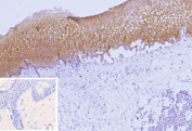 Immunohistochemistry analysis of Nectin cell adhesion molecule 4 / NECTIN4 antibody (clone NECTIN4/9906) in human skin tissue. Formalin-fixed, paraffin-embedded skin demonstrates strong membranous HRP-DAB brown staining within the epidermal keratinocyte layer, outlining cell-cell borders consistent with surface localization of Nectin-4. The underlying dermis shows minimal staining, supporting epithelial-restricted expression. Hematoxylin counterstain highlights tissue morphology and nuclei. The inset shows PBS used in place of primary antibody as a negative control, confirming absence of non-specific secondary antibody binding. Heat-induced epitope retrieval was performed by heating tissue sections in 10 mM Tris with 1 mM EDTA, pH 9.0, for 45 minutes at 95oC followed by cooling at room temperature for 20 minutes prior to staining.