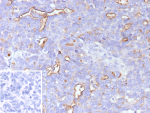 Formalin-fixed, paraffin-embedded human ovarian carcinoma stained with MUC16 Recombinant Rabbit Monoclonal Antibody (CA125/9923R). Inset: PBS instead of primary antibody; secondary only negative control.