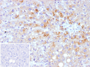 Immunohistochemistry of NS3 antibody in human HCV-infected liver tissue. FFPE human hepatitis C virus-infected liver demonstrates cytoplasmic HRP-DAB brown staining within hepatocytes, consistent with viral Non-structural protein 3 expression in infected cells. Clone rMMM33, a recombinant mouse monoclonal antibody, was used for detection. An inset image shows PBS substituted for the primary antibody as a negative control, confirming absence of specific staining. Heat-induced epitope retrieval was performed by heating sections in 10 mM Tris with 1 mM EDTA, pH 9.0, for 45 minutes at 95oC followed by cooling at room temperature for 20 minutes prior to staining.