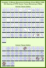 Immunohistochemistry of UPK1A Antibody for IHC in human tissue microarrays. Mouse monoclonal clone MSVA-735M shows strong membranous staining in normal urothelium of the urinary bladder, with minimal to absent staining in most non-urothelial tissues. In cancer tissue microarrays, selective membranous positivity is observed in urothelial carcinoma, while the majority of non-urothelial malignancies remain negative. Staining patterns are consistent with reported Uroplakin 1A expression profiles in the Human Protein Atlas.