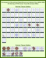 Immunohistochemistry of CHGA Antibody for IHC in human tissue microarrays. Recombinant rabbit monoclonal clone MSVA-380R demonstrates strong cytoplasmic granular staining in neuroendocrine tissues, including adrenal medulla, pancreatic islets, and scattered enteroendocrine cells of the gastrointestinal tract, while most non-neuroendocrine tissues show minimal to no staining. In cancer tissue microarrays, robust cytoplasmic positivity is observed in neuroendocrine neoplasms such as pheochromocytoma, small cell carcinoma, medullary thyroid carcinoma, and pancreatic neuroendocrine tumor, with limited staining in non-neuroendocrine malignancies. Staining patterns are consistent with reported Chromogranin A expression profiles in the Human Protein Atlas.