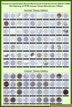 Immunohistochemistry analysis of formalin-fixed, paraffin-embedded human tissue microarrays stained with GS/Glutamine Synthetase antibody (clone MSVA-750M). Representative normal and cancer tissues show variable cytoplasmic brown chromogenic staining patterns across organ types, consistent with known tissue- and tumor-dependent expression of Glutamine synthetase, while nuclei are counterstained blue. The overall distribution and relative staining intensities observed across tissues are consistent with publicly available expression datasets for Glutamine synthetase.